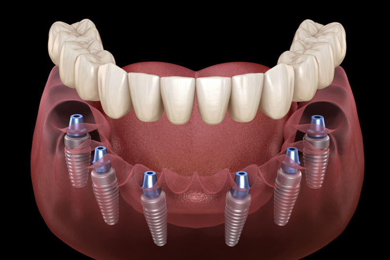 full mouth dental implants model.