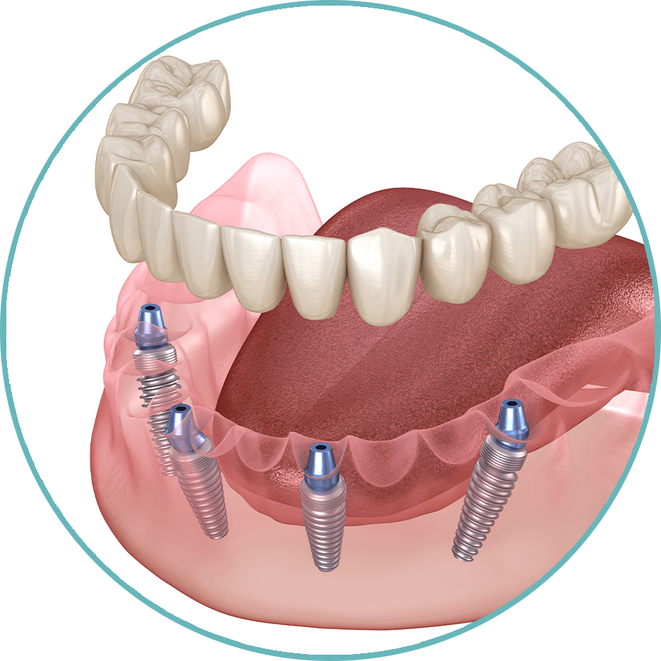 full mouth dental implants