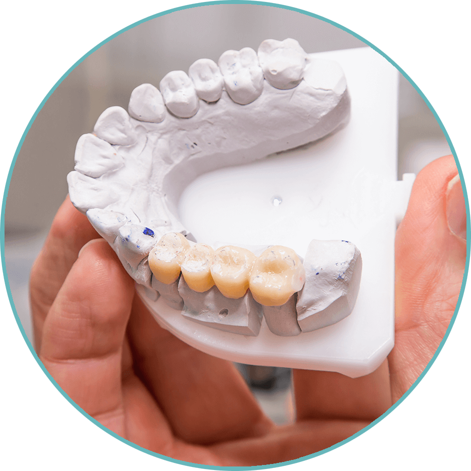 dental bridge