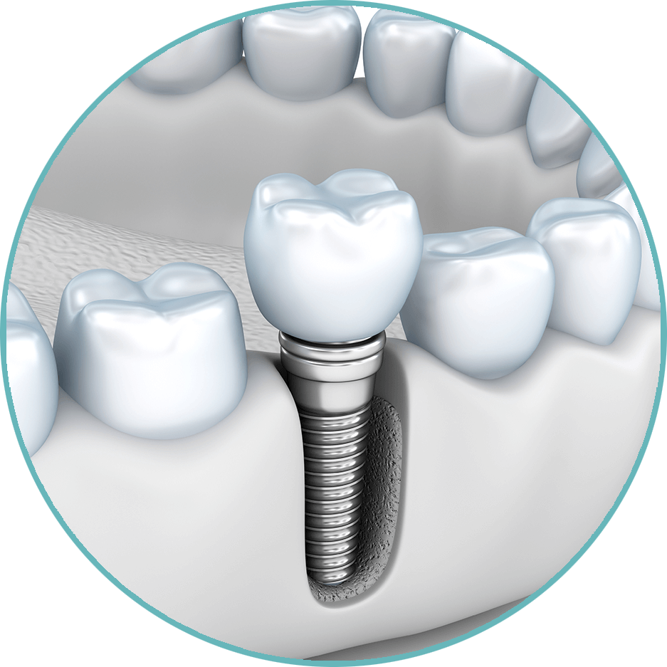 single dental implant