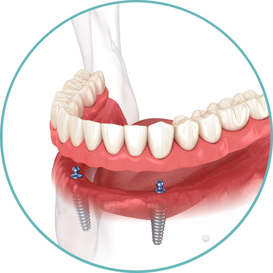 snap-on dentures