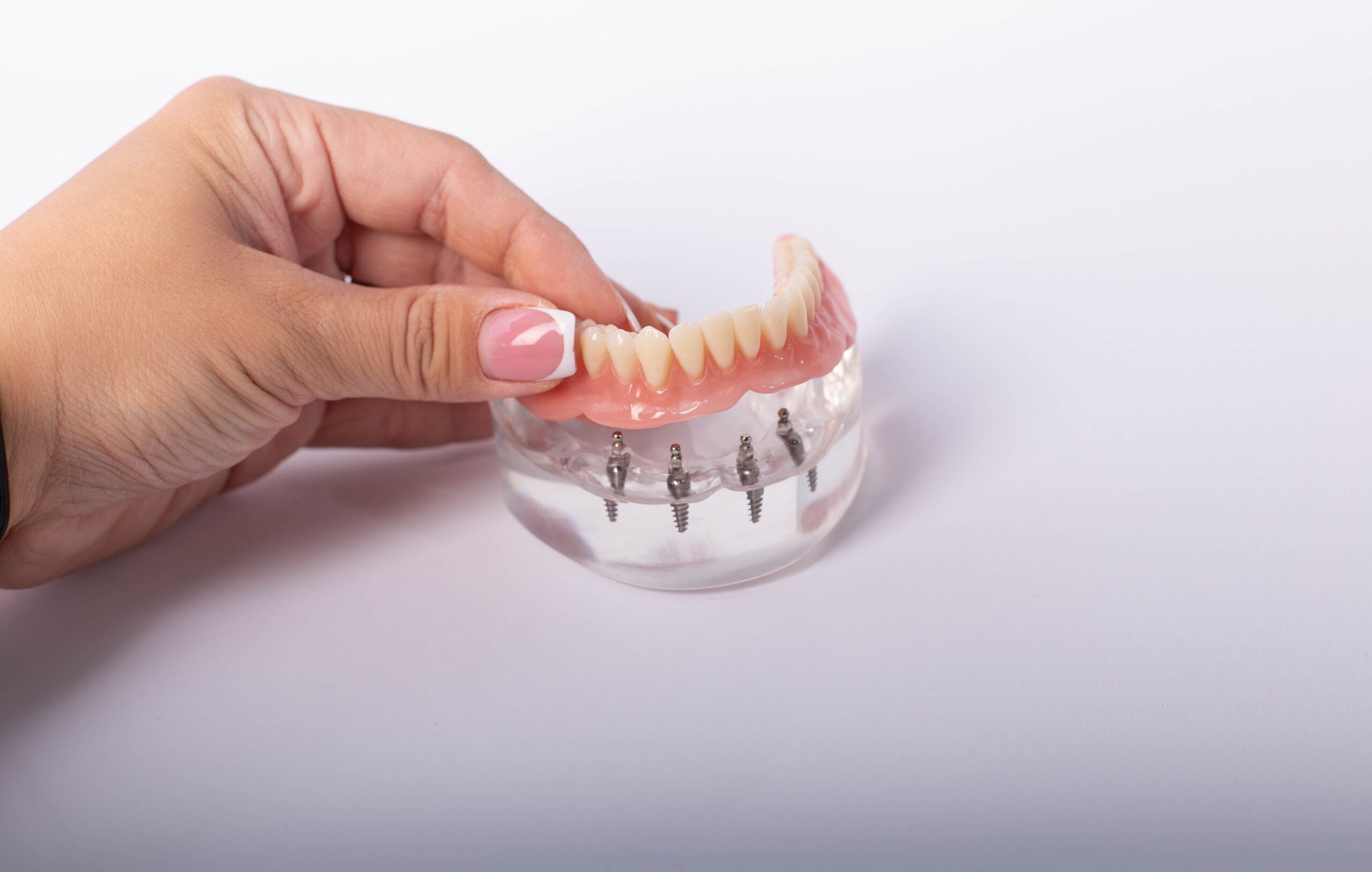 full mouth implant denture on four implants.