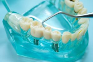 2 dental implants with crowns on top placed into the jaw